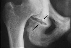 Снимок УЗИ перелом седалищной кости